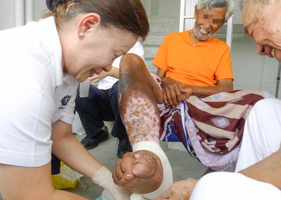 A Smile from an Elephantiasis Sufferer